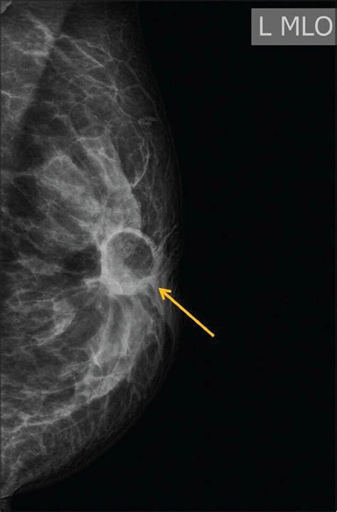 Mammographic And Sonographic Features Of Fat Necrosis Of The Breast