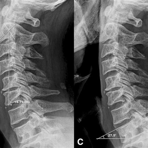 A The K Line Tilt B The C2c7 Sva C The T1 Slope D Cervical Lordosis