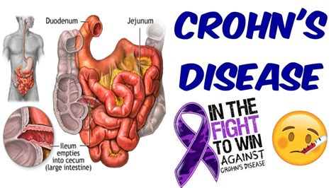 Crohns Disease The Only Video You Will Ever Need Youtube