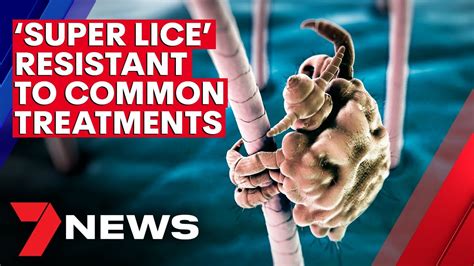 Super Lice Resistant To Common Methods Of Treatment 7news Youtube