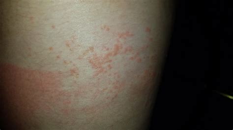 Hiv Skin Rashes Pictures Vrogue Co