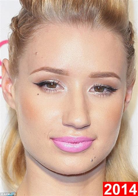 Iggy Azalea Before And After Photos Show Plastic Surgery