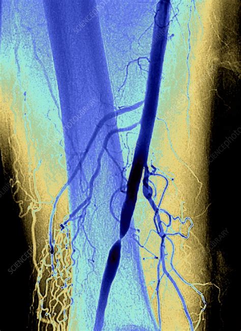 Nearly Blocked Femoral Artery Angiogram Stock Image C0480654