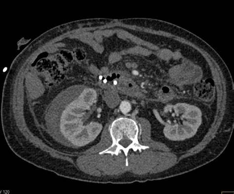Perirenal Hematoma Right Kidney Kidney Case Studies Ctisus Ct Scanning