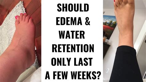 Edema Water Retention Swelling Lasting Longer Than A Year In Recovery Youtube