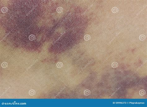 Closeup On A Bruise On Wounded Woman Leg Stock Image Image Of Person