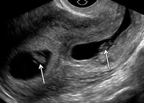 Ectopic Pregnancy A Trainees Guide To Making The Right Call Womens Imaging RadioGraphics