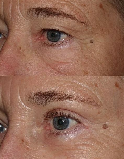 Endoscopic Brow Lift Dr Guy Massry