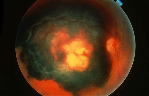 Central Hemorrhagic Disciform Lesion Retina Image Bank
