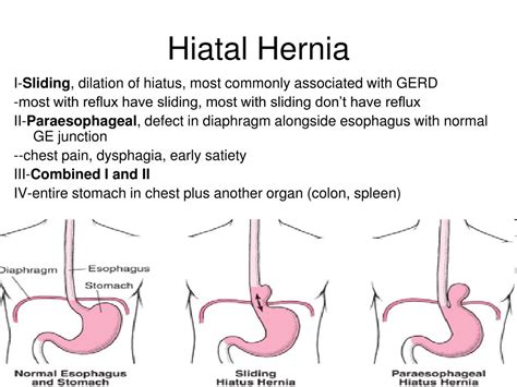Hiatal Hernia Surgery Recovery Minimally Invasive Surgical