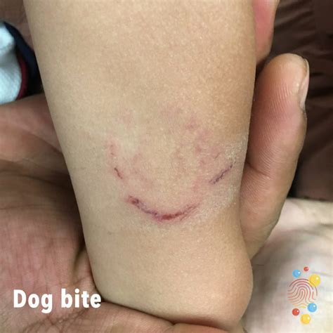Can Dog Bites Cause A Rash