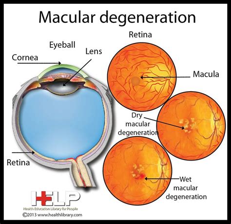 Macular Degeneration Eye Eye Facts Nurse Teaching Optometry