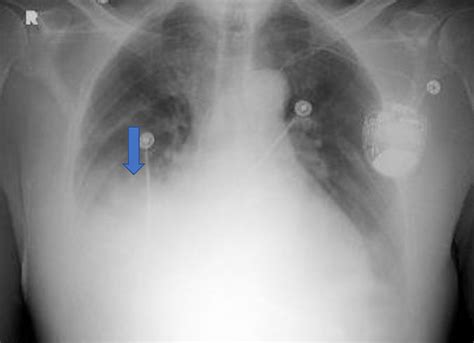 Chest X Ray Revealing A Right Middle Lobe Infiltrate Blue Arrow