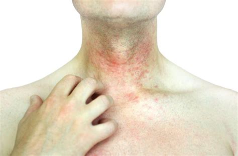 Atopic Dermatitis Ad Also Known As Atopic Eczema Is A Type Of Skin