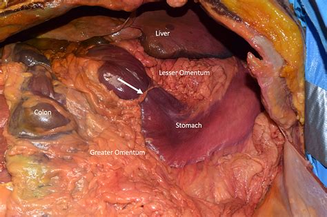 Abdominal cavity anatomy, download this wallpaper for free in hd resolution. Cureus | Constriction of the Stomach by an Unusual ...