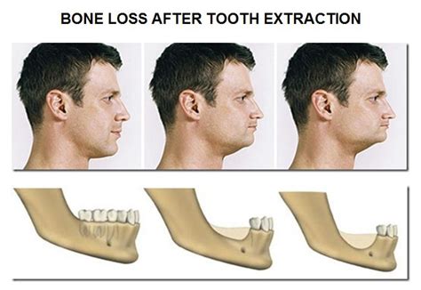 The Challenges Of Dentures