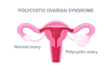 Premium Vector Polycystic Ovary Syndrome Pcos Hormonal Diagnose Female Reproductive System