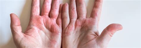 Contact Dermatitis On Hands Minpngv1678690429