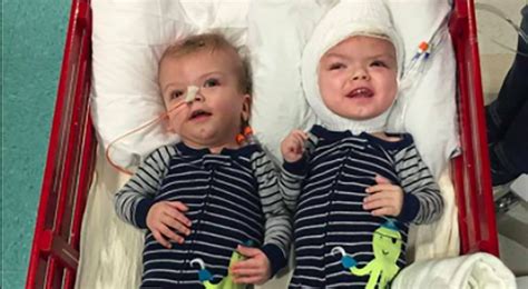 Formerly Conjoined Twins Beating The Odds After Separation Surgery