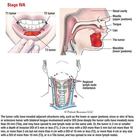 Head And Neck Oral Cancer