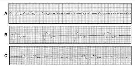 Pulseless Electrical Activity Vs Asystole