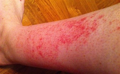 Itchy Rash On Legs Common Skin Rashes Pictures Causes Common Skin The