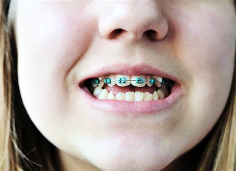 4 Ways Braces Make Your Life Better Dunn Orthodontics
