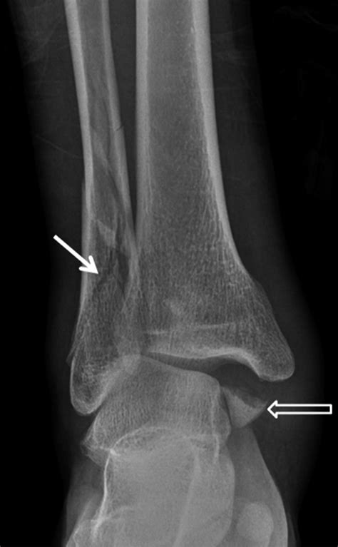 Spiral Fracture Foot
