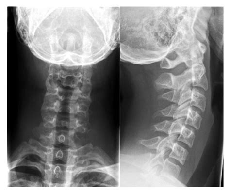 The Ap View Of The Preoperative Conventional X Ray Of The Cervical