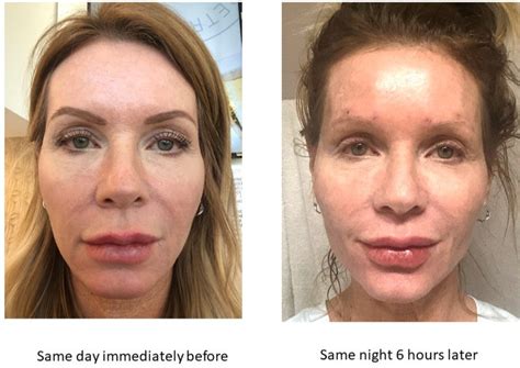My Experience With Silhouette Instalifttm Face Thread Lift Before