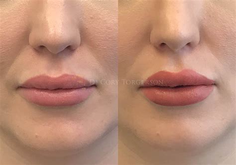 Lip Flip Before And After Gallery Dr Cory Torgerson
