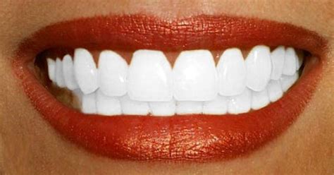 11 Remèdes Naturels Pour Avoir Des Dents Blanches