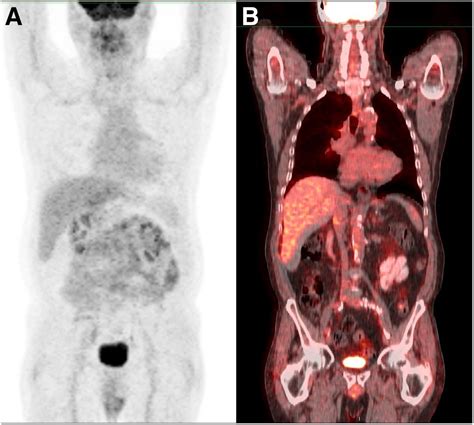 Pet Scan Images Lung Cancer