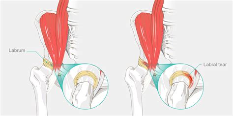 Exercises For Internal Snapping Hip Syndrome Online Degrees