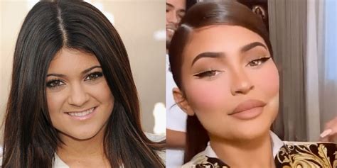 The Kardashians Kylie Jenner Plastic Surgery Timeline