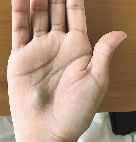 Mans Hand Lump Found After Dental Procedure Turns Out To Be Sign Of