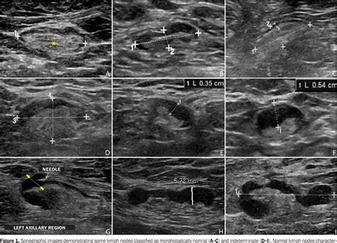 Figure 1 From Axillary Ultrasound And Fine Needle Aspiration In