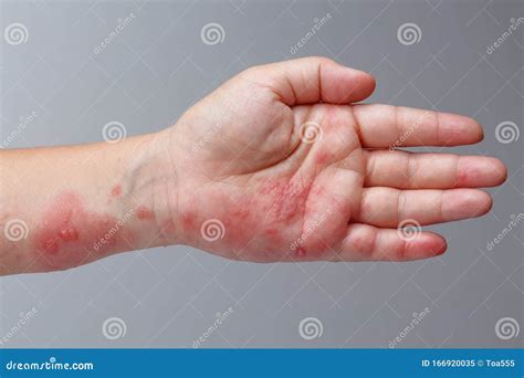 Shingles Zoster Or Herpes Zoster Symptoms On Arm Stock Image Image