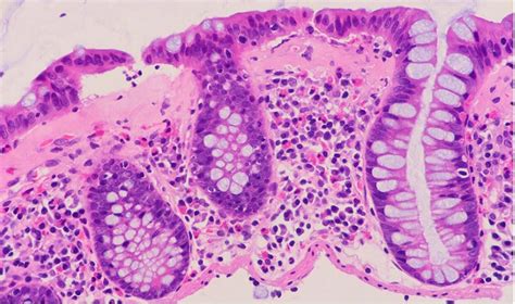 Mistakes In Microscopic Colitis And How To Avoid Them Ueg United