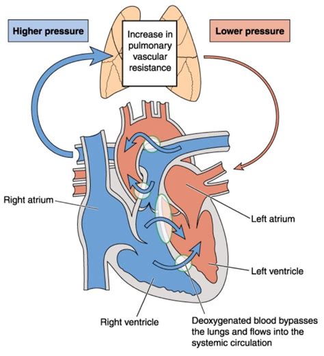 Pulmonary Arterial Hypertension Page 4 Things Health