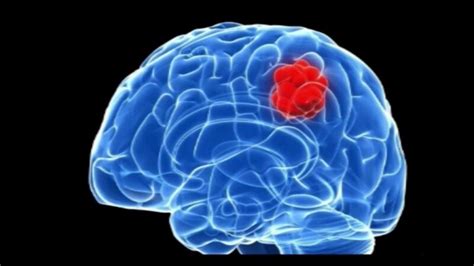 Giant Tumors On The Brain Rsubsimgpt2interactive