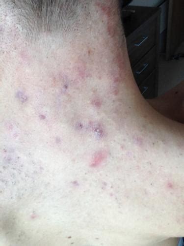 Purple Marks From Cystic Acne Back Of Neck Help