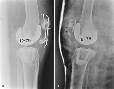 Extensor Mechanism Disruption After Total Knee Arthroplasty