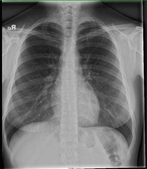 Coronary Calcification On Chest X Ray X Rays Case Stu
