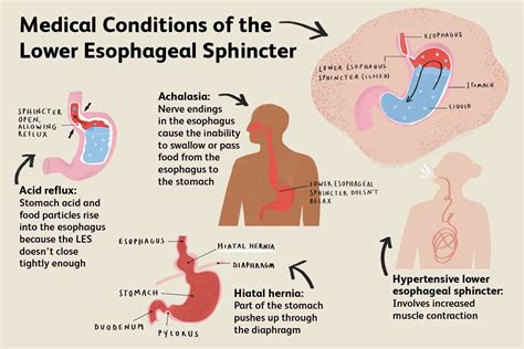 Lower Esophageal Sphincter Anatomy Function Treatment
