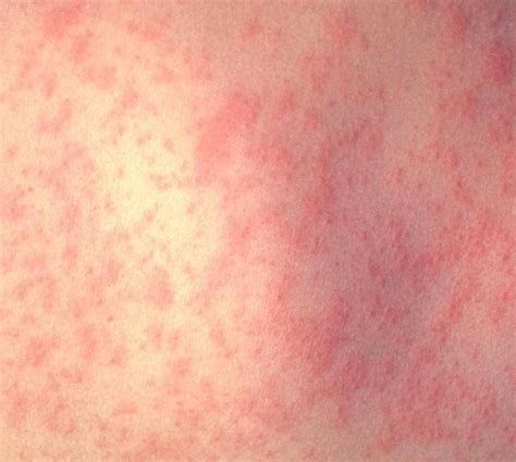Viral Meningitis Symptoms Causes Treatment Pictures