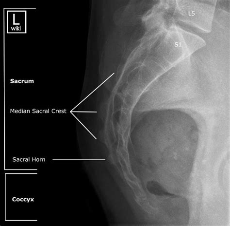 Radiographic Anatomy Sacrum Lateral Radiology Schools
