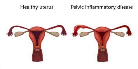 Inflammation is the body's normal response to illness and infection. Pelvic Inflammatory Disease- Symptoms, Causes, Risk ...