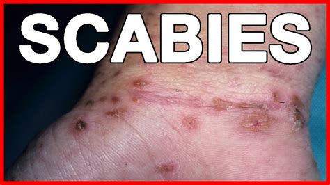 How To Deal With Scabies Or Crusted Scabies Treatment Cure Signs