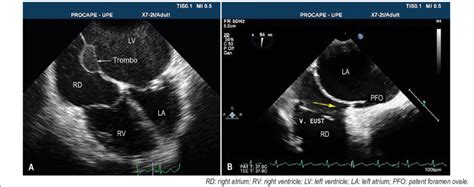 A Transesophageal Echocardiogram Showing An Interatrial Septal